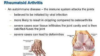 Inflammatory Joint Disorders