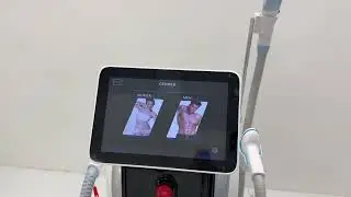 808nm diode laser hair removal machine