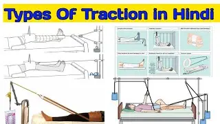 Types of traction in hindi| traction control system| traction force in orthopedics|
