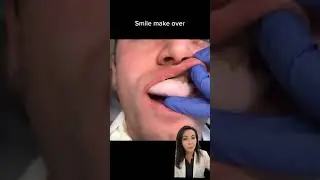 How We Do Temporary Veneers?!