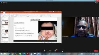 Cleft lip case presentation