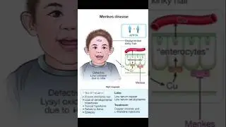 Menkes disease = defective copper transport &rarr; low copper &rarr; kinky hair, developmental delay, seizures