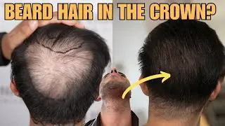 Can You Transplant Beard Hair In The Crown? Dr. Felipe Pittella Answers