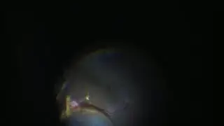 Excision of retinal capillary hemangioblastoma with serous retinal detachment UNEDITED