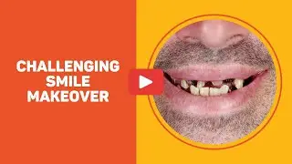 Difficult and Challenging Smile Makeover -  One Central Tooth - Moving the Midline