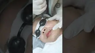 How to remove Freckles Permanently #freckles #lasertreatment #shorts