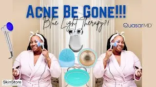 I Tried Blue Light Therapy for Acne! Quasar Baby Blue Review + Save 25% on Beauty & Skincare Tools!