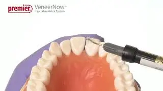 VeneerNow&trade; Injectable Matrix System - Restoration of a Fractured Incisor or Class IV Restoration