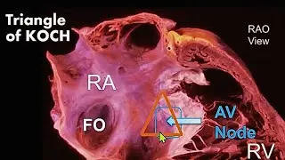 AV Node in the Triangle of Koch