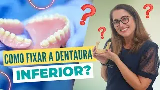 Como fixar a dentadura inferior? Adornare Odontologia Estética em Santos