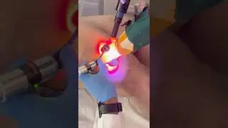 Tratamento de varizes finas com laser #varizes #varizesnuncamais
