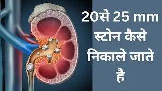 Kidney surgery removal surgery||kidney stone remove kaise kare||kidney stone||kidney stone||kidney