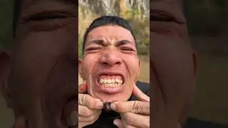 How I cured Bug 🐞 Bite 😃with yogurt in the wild🤪🤪|Survival Hack