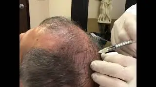 Board Certified Plastic Surgeon, Dr. Robert Kessler, Discusses & Performs PRP for Hair Loss