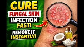 Fungal Skin Infection Relief | Natural Remedies That May Help
