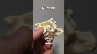 Breaking Point: Rupture of Cervical Disc Model #cervicaldisc