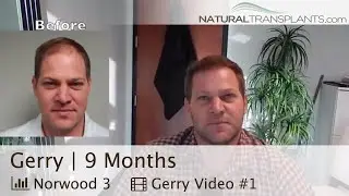 Hair Transplant Surgery | 9 Month Best Hair Transplant Surgery Video (Gerry)