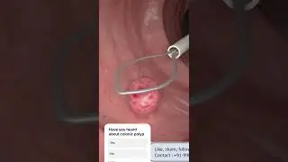 Polypectomy for colonic polyp