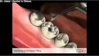 Esthetics And Restorative - Replacing An Amalgam Filling - Dentist Ottawa