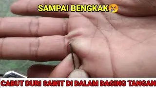 CABUT DURI SAWIT DI DALAM DAGING TANGAN #cabutduri #cabutdurisawit #splinter
