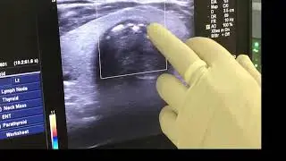 The great value of tracheal U/S before per cutaneous tracheostomy [live study]