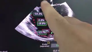 2D Speckle Tracking RV Strain by TEE in case of ASD !!