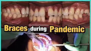 My sister-in-law got Braces during this Pandemic | VLOG