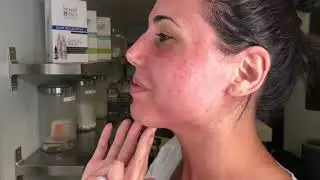 Butterfly Facelift