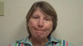 Cosmetic Surgery San Ramon | CO2 FX Fractional Resurfacing Testimonial