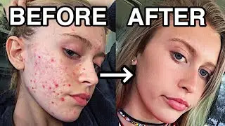 HOW I CLEARED MY ACNE *FAST* // SKINCARE ROUTINE 2017