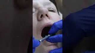 All on 4 Placement