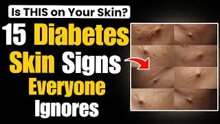 15 Diabetes Symptoms Your Skin Reveals Before It's Too Late (Most Miss #12!)
