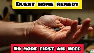 How to Treat a Minor Burn on Hand at Home |Hand Burns Relief |Burnt Hand Remedy