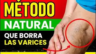 ADULTOS MAYORES: REMEDIOS NATURALES para quitar VARICES y mejorar la circulaci&oacute;n