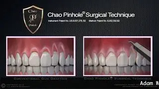 Receding Gum Treatment - Pinhole Surgical Technique - Greenwood Village CO - Dr Weaver