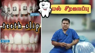 TOOTH CLIP🦷  | DR.BHASKER VLOGS 🤩
