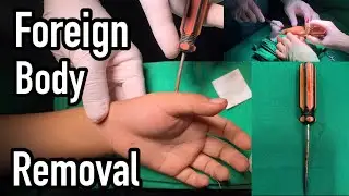 FOREIGN BODY REMOVAL - HAND | PUNCTURE WOUND