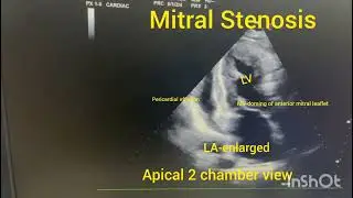 2D echo Apical 2 chamber view, LA-enlarged,doming of anterior mitral leaflet, pericardial effusion