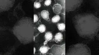 how to prevent encephalitis? #encephalitis #brain