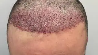 Cirugía Reparadora Capilar, Hair Repair Surgery, Dr Xavier Álvarez, Injerto Capilar