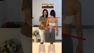 Essential exercise for managing scoliosis. strengthen your core and improve spinal health #scoliosis