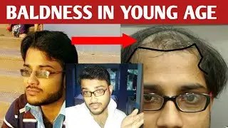 Baldness in teenage male | Hair heal talks.