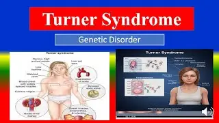 TURNER SYNDROME-  Definition, types, causes, pathophysiology, symptoms , diagnoses , medicine