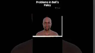 Bell's palsy is characterised by muscle weakness that causes one half of the face to droop.#physio
