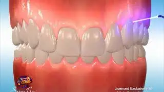 Excess Gingival Reduction