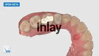 Designing an Inlay with the Medit ClinicCAD (Beta) App