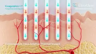 Introducing UltraClear's 3DIntelliPulse® Technology