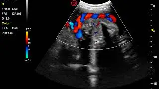 Umbilical cord blood flow by Clover 60