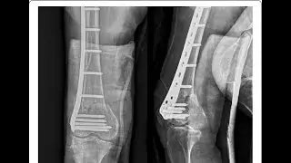 Joint incongruity; articular surfaces of a joint do not fit together properly