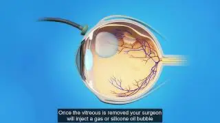 Retina Detached Vitrectomy surgery